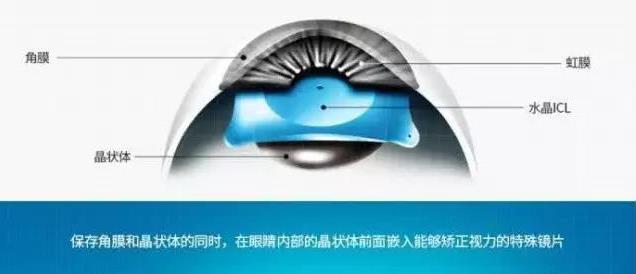 合肥普瑞眼科—都是近视手术,凭什么ICL这么贵?