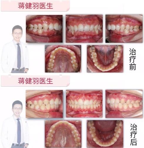 潜心学术,厚积薄发---推动中国隐形正畸创新的领头羊是谁