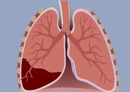 什么是胸腔积液?引发胸腔积液的原因