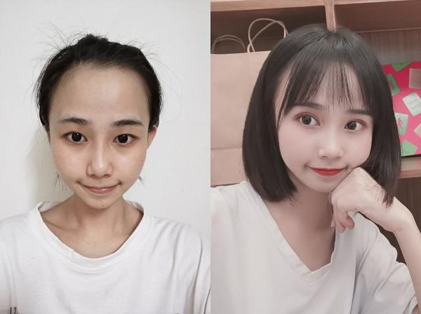 王的整形王海木:双眼皮修复这些问题不能忽视