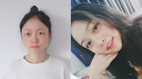 王的整形王海木:双眼皮修复这些问题不能忽视
