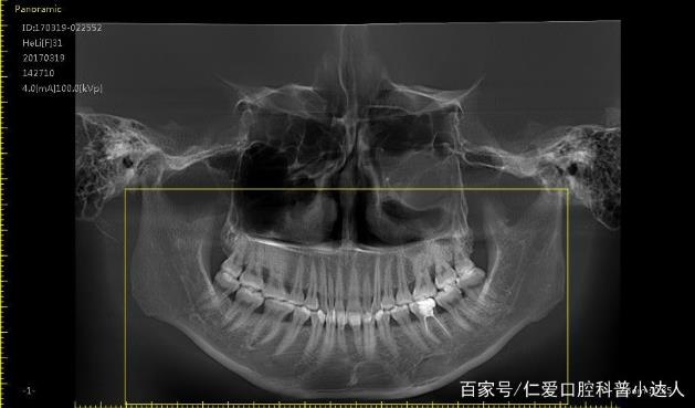 武汉仁爱口腔 骨性前突隐适美矫正案例分享