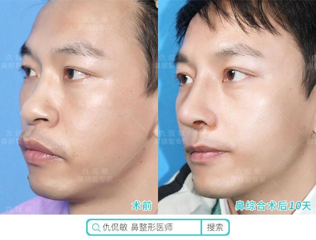 仇侃敏:聚焦鼻整形中的男性客群——那个音乐剧演员(6)