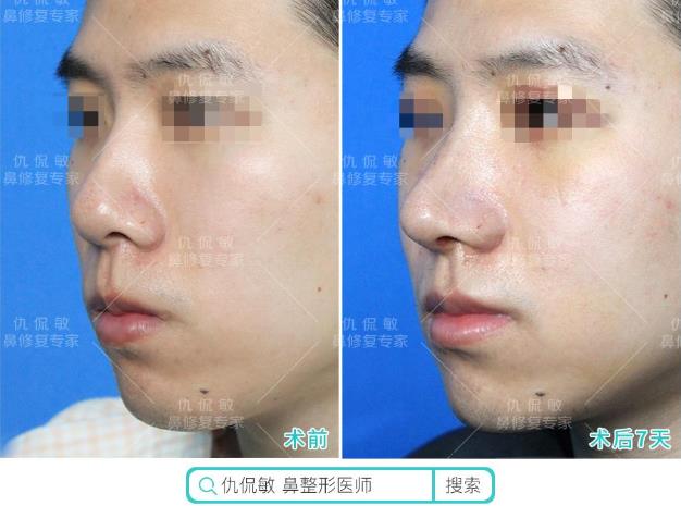 仇侃敏:聚焦鼻整形中的男性客群——那个音乐剧演员(6)