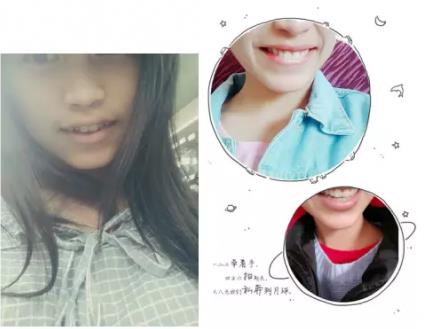 岳阳牙齿矫正会后悔吗?分享他们的牙齿矫正经历!