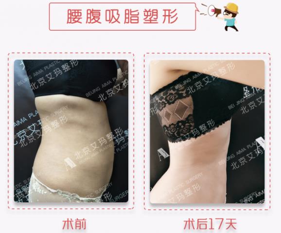 艾玛整形白馨月:吸脂术前要了解哪些问题?