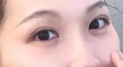 割双眼皮前有哪些注意事项 王的整形王海木院长告诉你