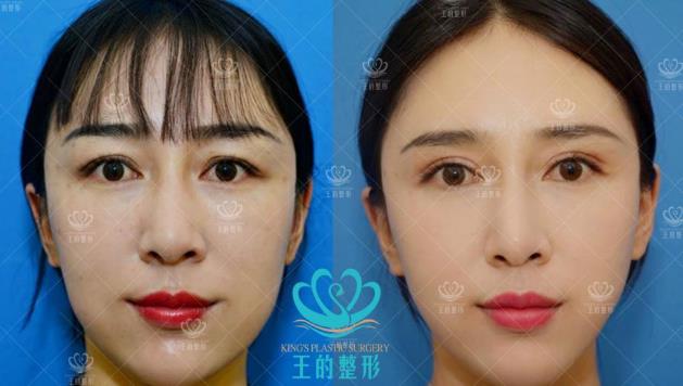 割双眼皮前有哪些注意事项 王的整形王海木院长告诉你