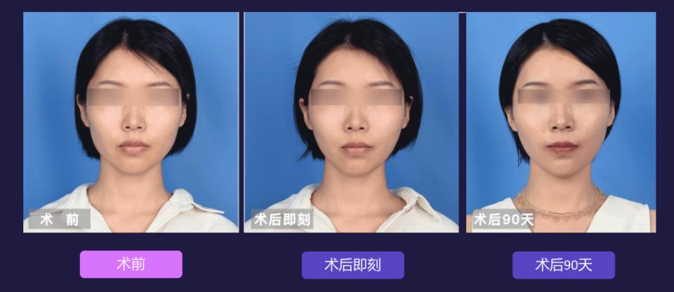 宁波艺星整形医院:7D黄金超声炮,深层抗衰,一次抵三次热玛吉!