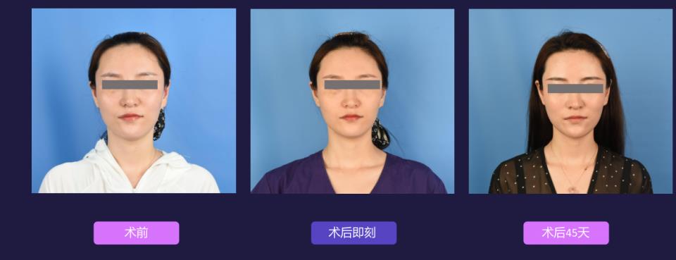 宁波艺星整形医院:7D黄金超声炮,深层抗衰,一次抵三次热玛吉!