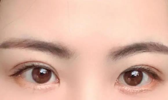 割双眼皮前有哪些注意事项 王的整形王海木院长告诉你