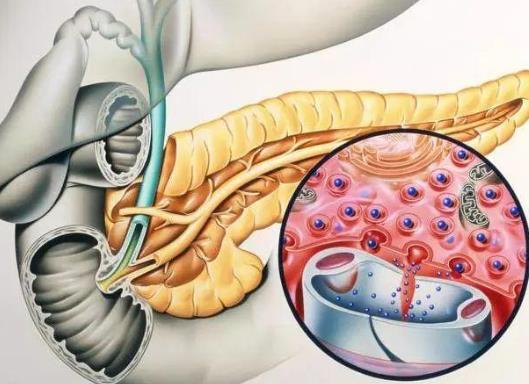 胰腺炎是怎麼引起的胰腺炎的症狀是什麼
