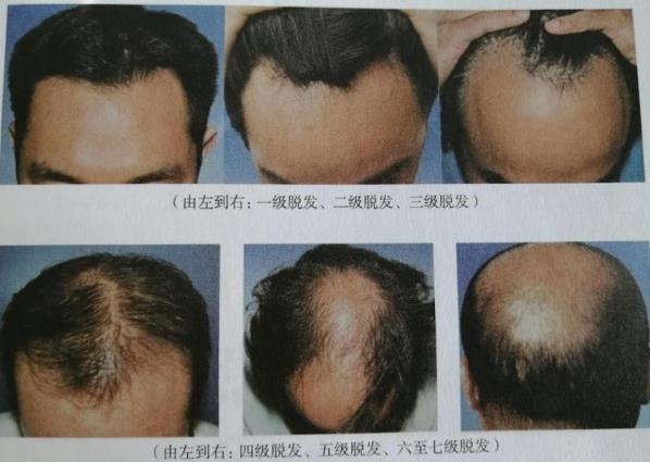 北京熙朵植发专科医院:如何判断自己脱发是什么等级?植发要多少钱?