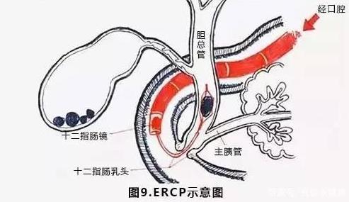 胆管炎要治疗多久?胆管炎的危害是什么