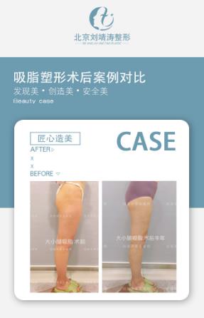 考虑做大小腿吸脂手术可以先让医生面诊在做手术——北京吸脂医生刘靖涛