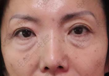 不开刀祛眼袋:早睡能把眼袋睡没吗?答案很意外!