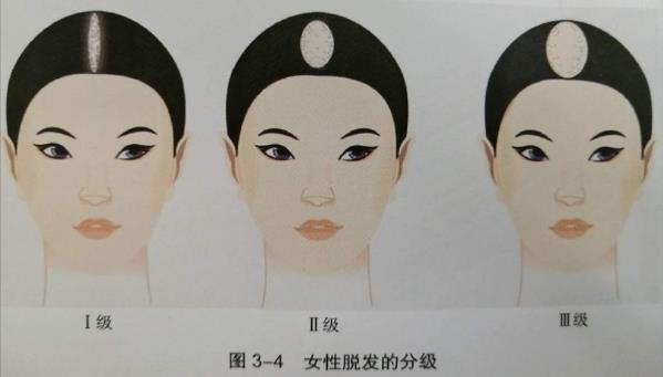北京熙朵植发专科医院:如何判断自己脱发是什么等级?植发要多少钱?