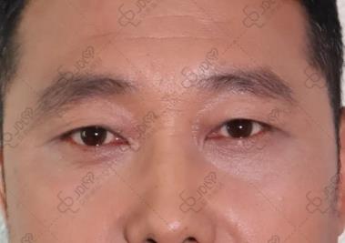 不开刀祛眼袋:早睡能把眼袋睡没吗?答案很意外!