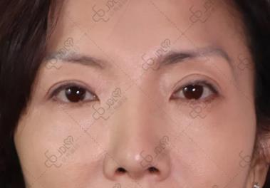 不开刀祛眼袋:早睡能把眼袋睡没吗?答案很意外!