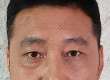 不开刀祛眼袋:早睡能把眼袋睡没吗?答案很意外!
