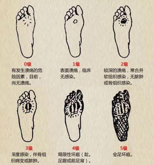 山东治疗糖尿病足优质推荐医院