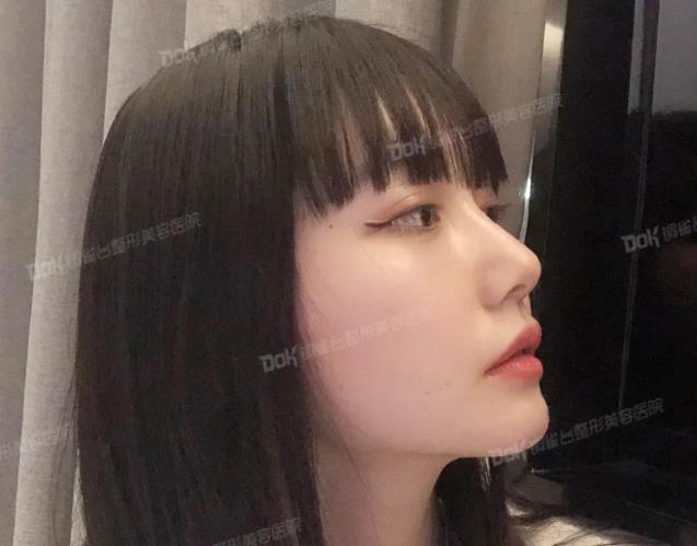 云南铜雀台整形医院赵兰明隆鼻好不好 汇集多年东方美鼻精华