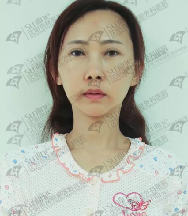 沈阳杏林整形医院自体脂肪填充案例
