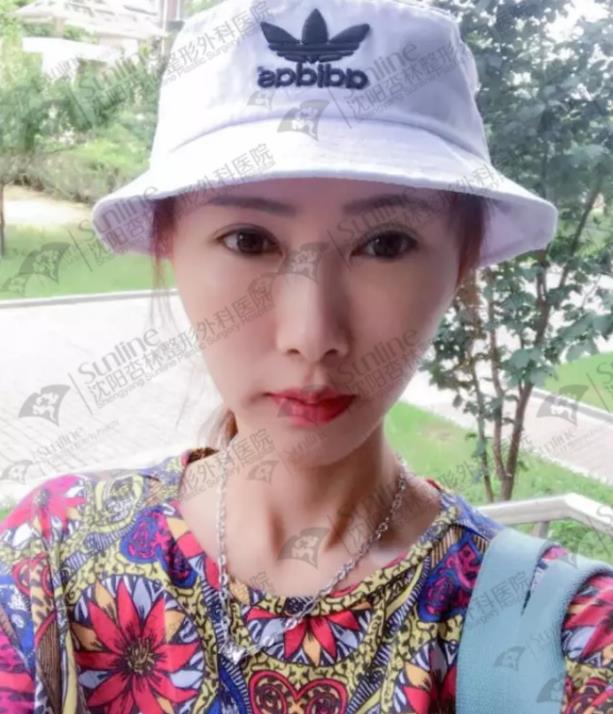 沈阳杏林整形医院自体脂肪填充案例