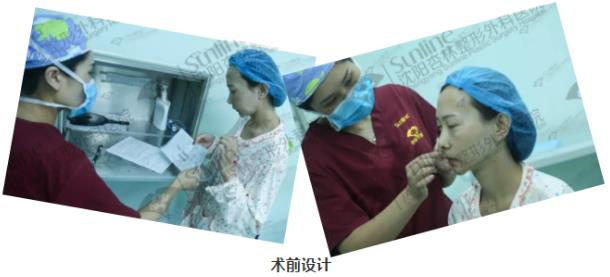 沈阳杏林整形医院自体脂肪填充案例