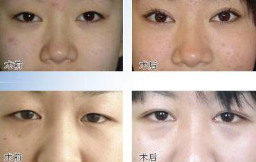 都是双眼皮,为什么选李方奇立体缝合双眼皮术?