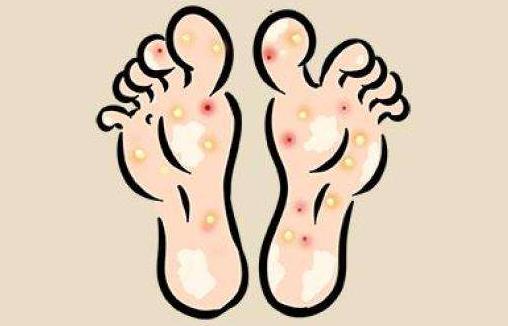 不同的脚气病怎么办?脚气病有哪些症状分类?