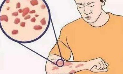 接触性皮炎有哪些危害?为什么会患接触性皮炎?