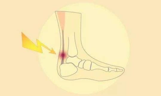 患跟腱炎有哪些病因?患跟腱炎怎么办?