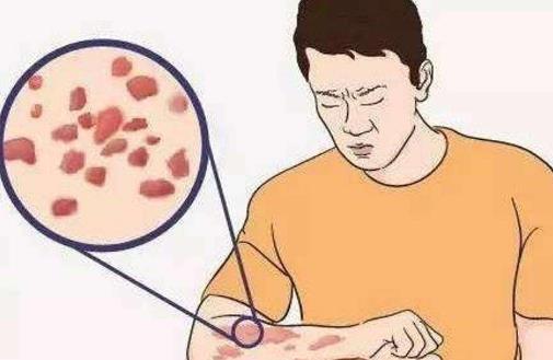 过敏性皮炎会传染吗?过敏性皮炎有哪些症状?
