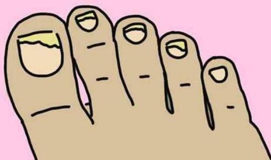 哪些人容易患灰指甲?灰指甲的日常护理有哪些?