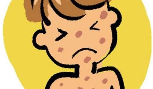 患了麻疹有哪些并发症?怎么预防麻疹?