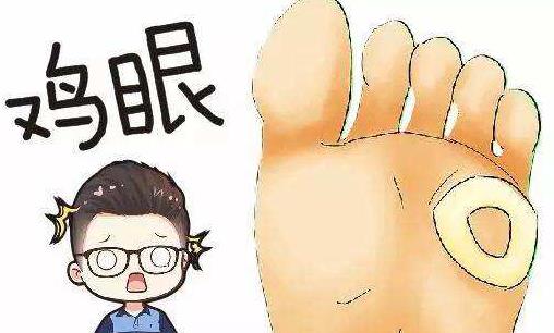 鸡眼是什么?鸡眼形成的原因有哪些?