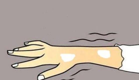 哪些人容易患白癜风?患白癜风的早期症状有哪些?