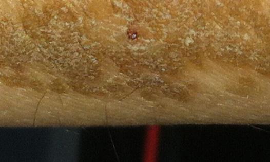 硬皮病有哪些症状?硬皮病有哪些并发症?