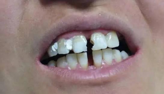 怎么预防牙缝变大?牙缝变大可以怎么办?