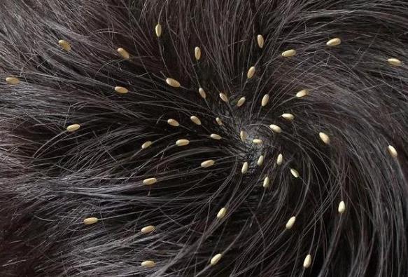 头上有虱子怎么去除掉?虱子是怎么长出来的?虱子和跳蚤区别