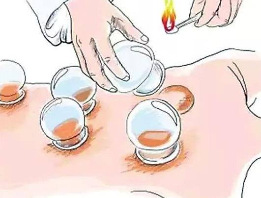 拔罐洗澡了会怎样?拔火罐烫了一个大泡怎么办