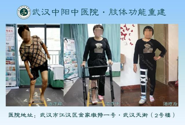 50年“马蹄足”苦不堪言,中医骨伤·矫形技术助力放平双脚,平稳行走