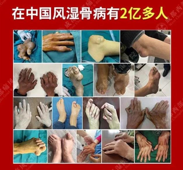 北京教授/博士天团来蓉,三甲专家团免费为您看风湿骨病