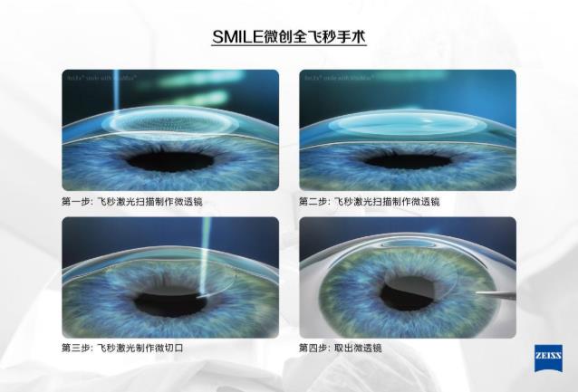 近视考生填报专业很吃亏?!郑州尖峰眼科医院助你摘镜圆梦