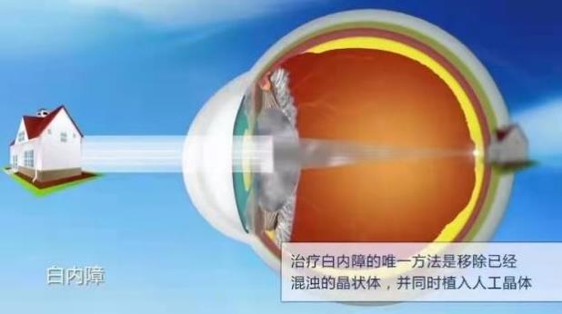 上海眼科专家化身主播,中秋佳节陪老人家共话白内障、老花那些事