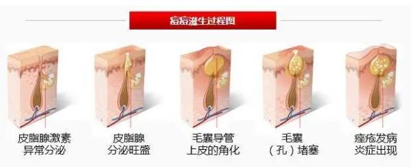 博士说痘||除痘根之逼进痘痘老巢的清剿 ——细说细胞祛痘之五