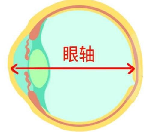北京茗视光眼科:眼轴增长1mm孩子近视就增加300度吗?